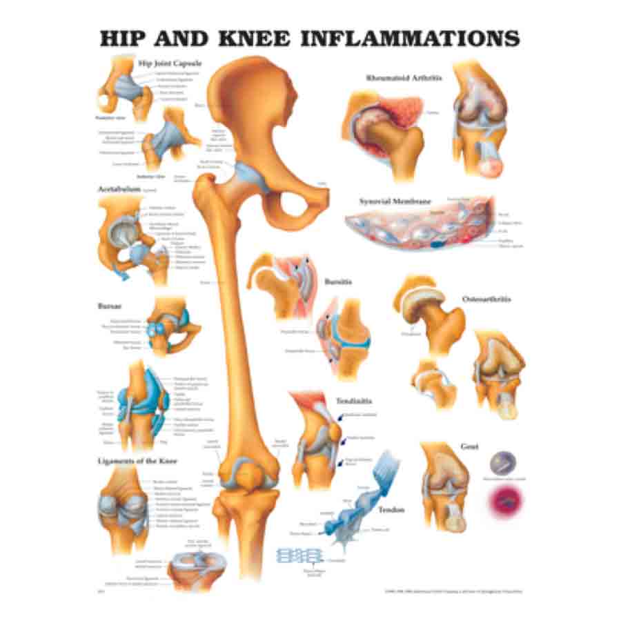 CHART HIP AND KNEE INFLAMMATION